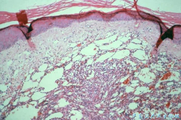 卡波西肉瘤（显微图片）