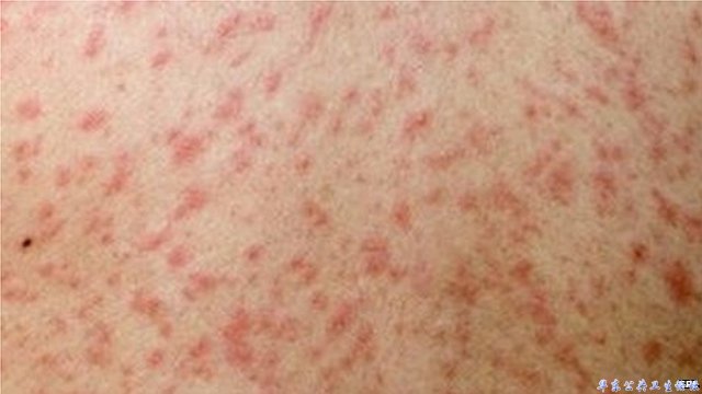 麻疹A（measles)