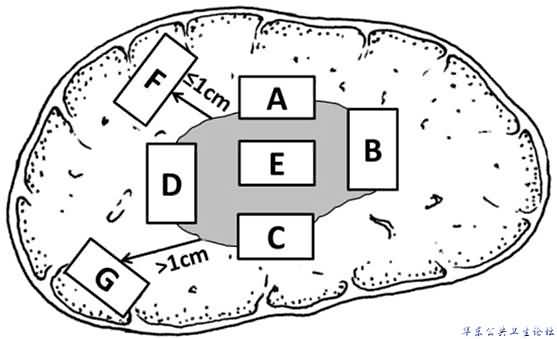 肝脏肿瘤标本基线取材部位示意图
